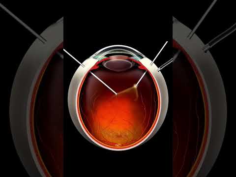 How is vitrectomy done? Vitrectomy can change your life if you have diabetic retinopathy